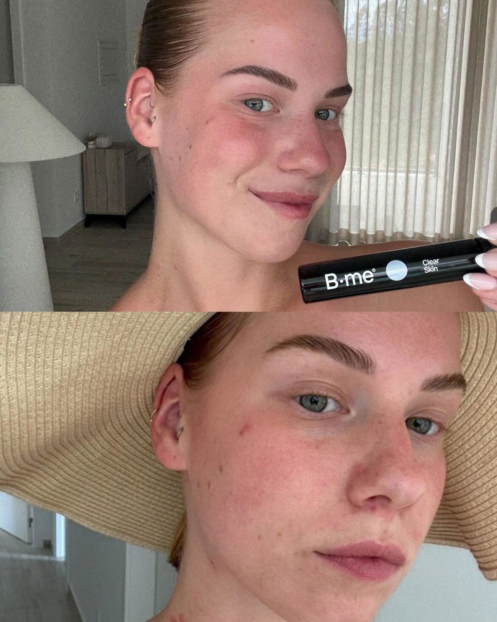 Clear skin*