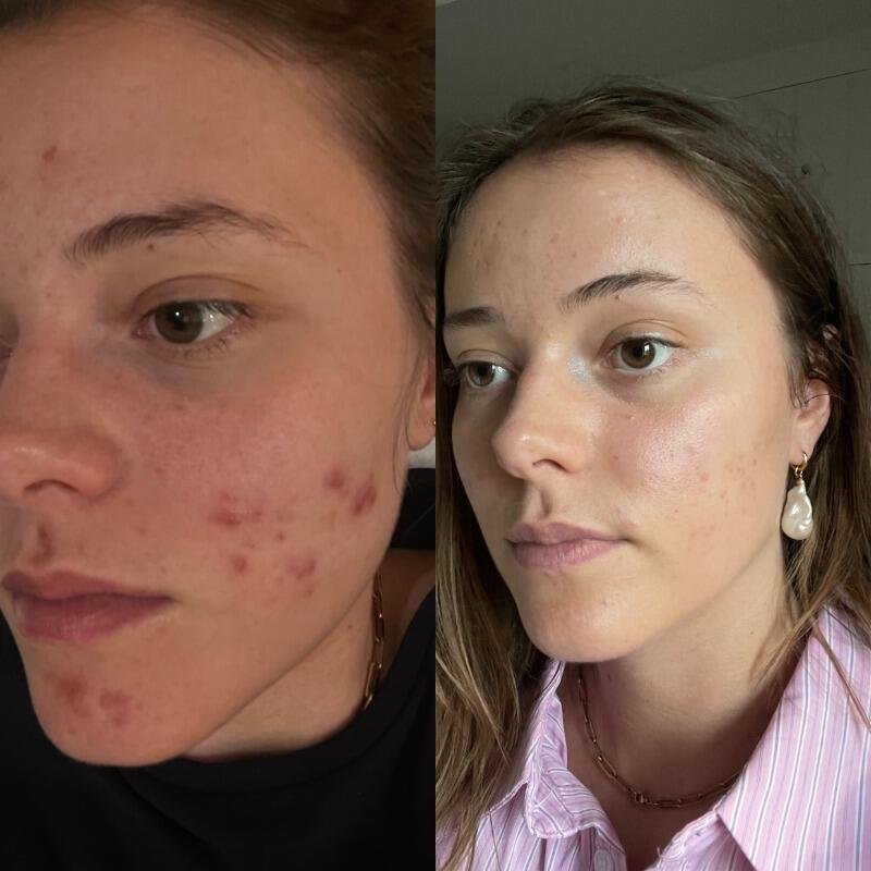 Clear skin*