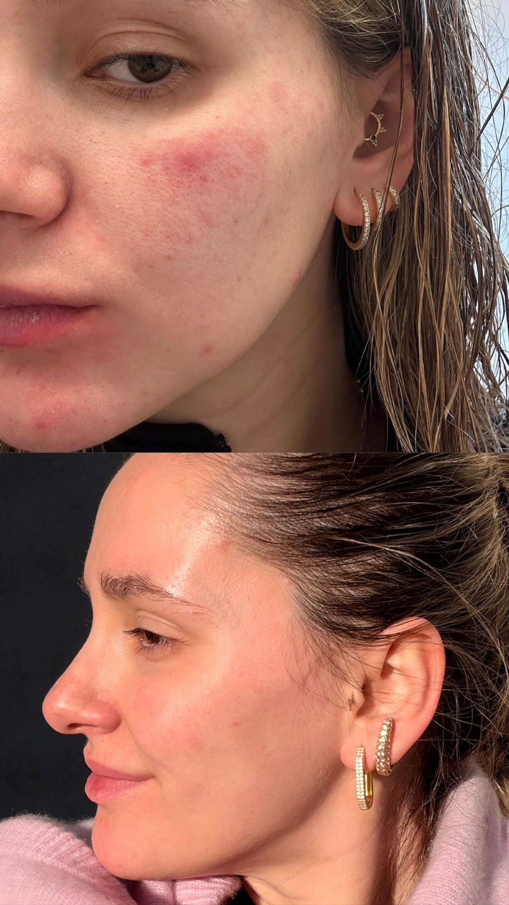 Clear skin*