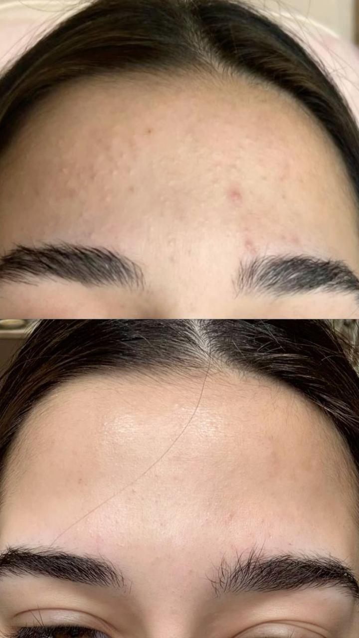 Anti Acne Duo