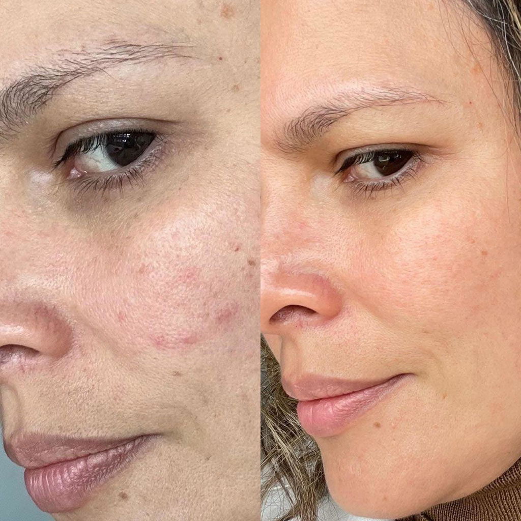 Anti Acne Duo