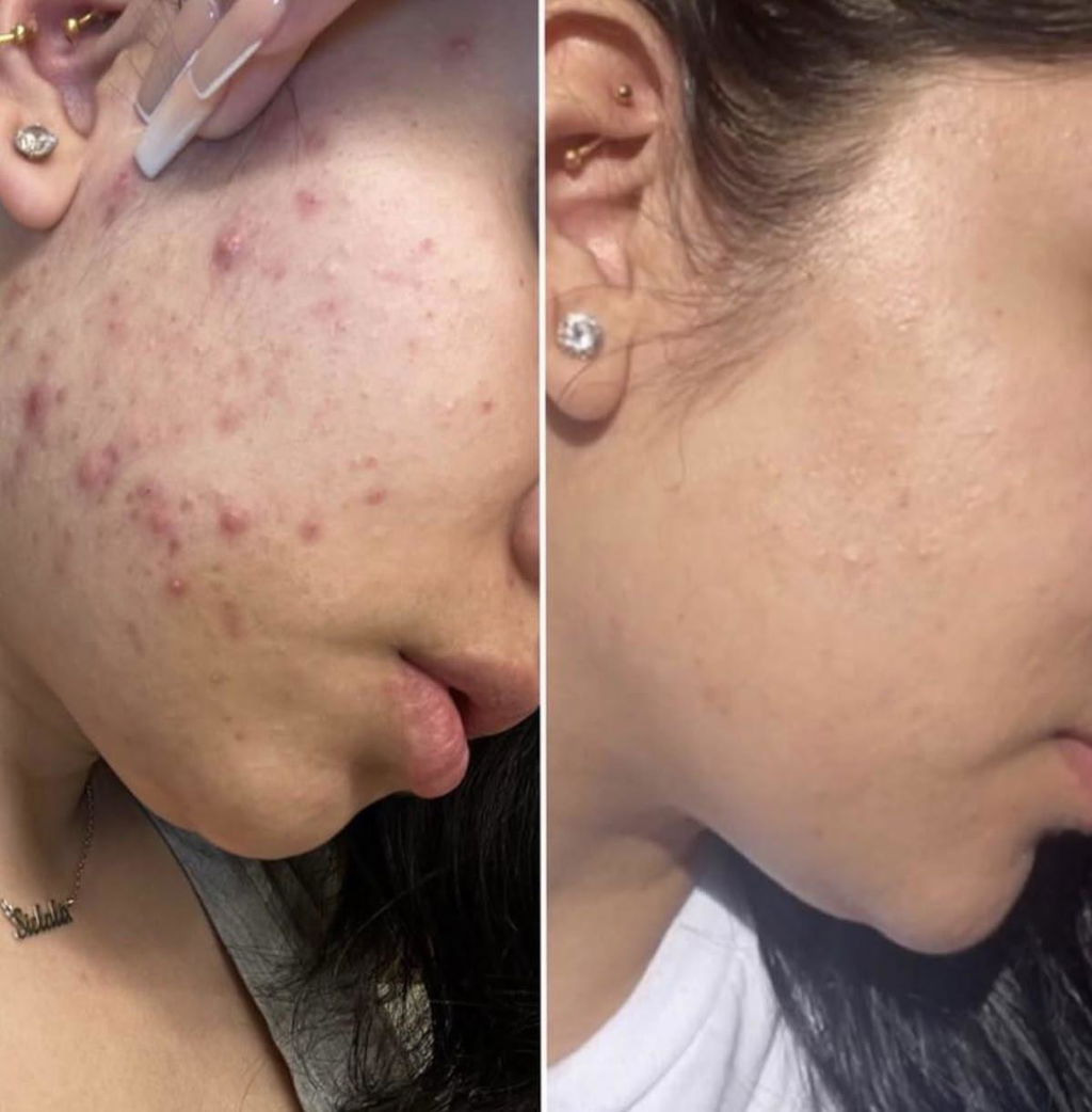Anti Acne Duo