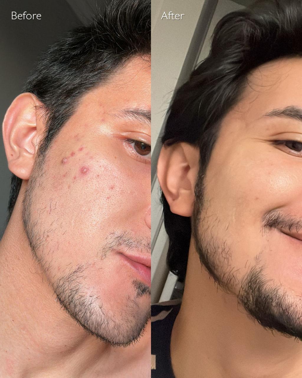 Anti Acne Duo