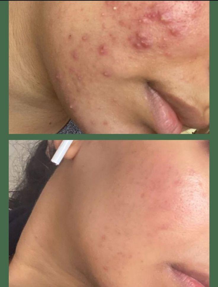 Anti Acne Duo