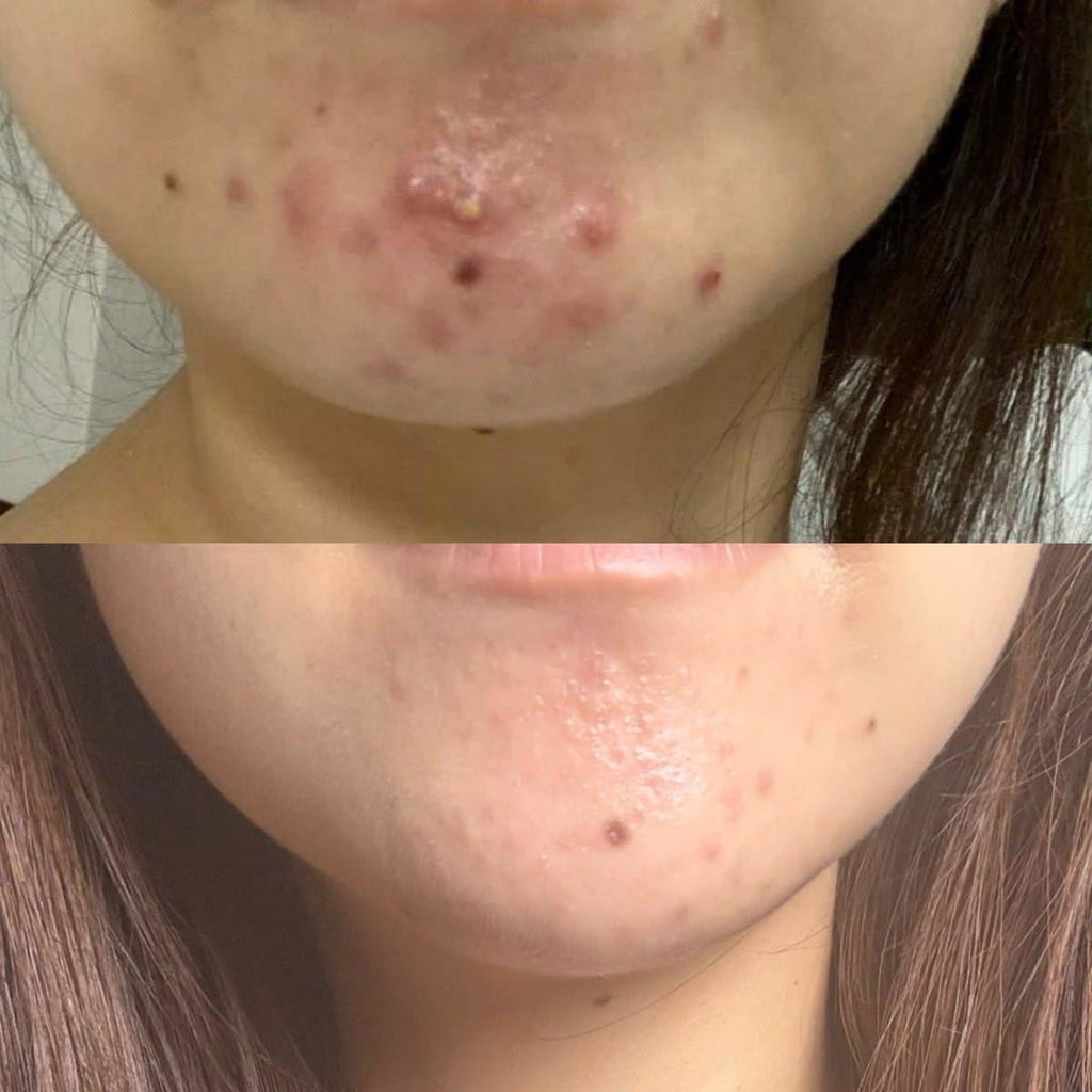 Anti Acne Duo