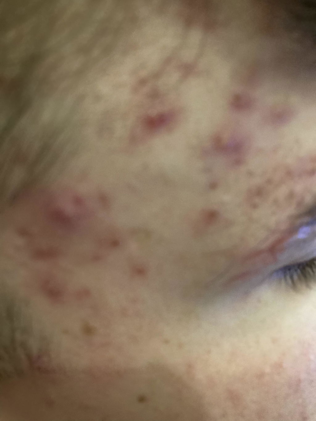 Hydrobiotic - Lavender & Mint - intensive care for Acne