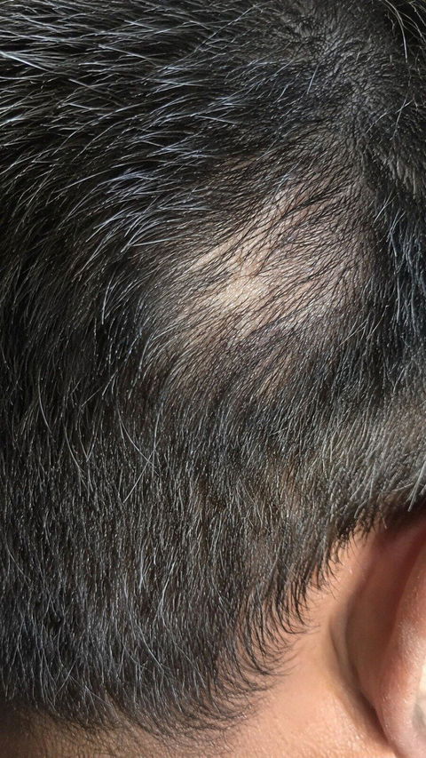 Advanced Ayurvedic Formula for Alopecia Treatment | Doctor Recommended | 100% Safe & Effective