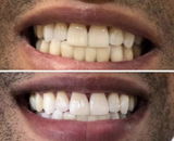 PAP Teeth Whitening Strips with Hydroxyapatite – 28 Strips (14 Day Treatment)