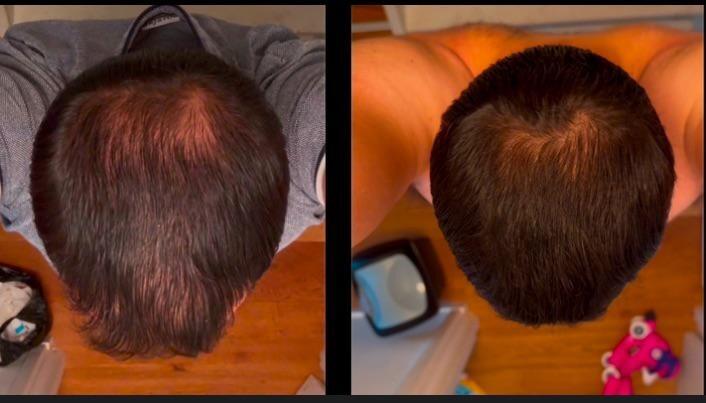 ShinyHair - Follicle Support Complex - for men