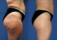 CelluVac Pro™  3-i-1 för behandling av celluliter och bristningar
