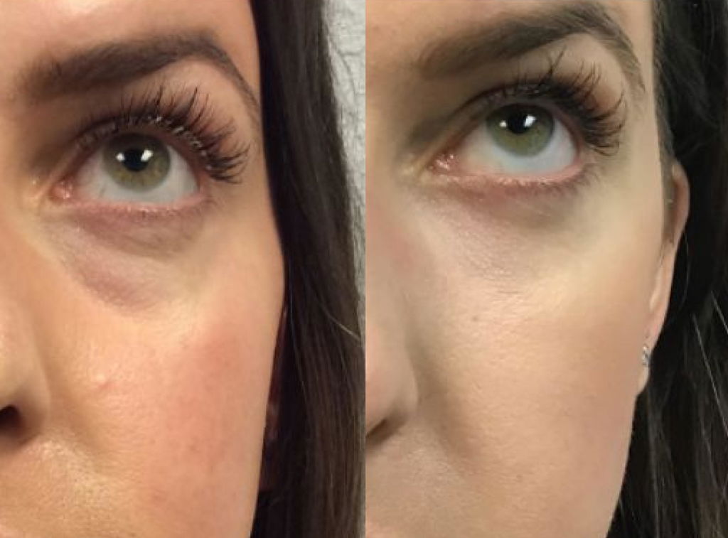 ISA ✨ VARITA MAGIC LED FACIAL